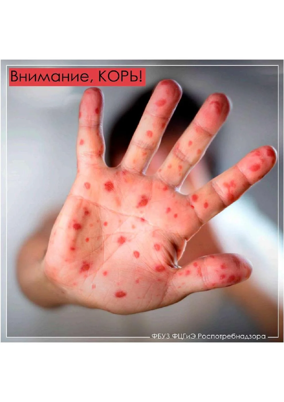 ВНИМАНИЕ! КОРЬ!