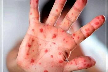 ВНИМАНИЕ! КОРЬ!